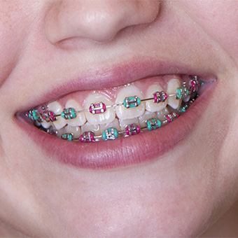 Types Of Braces | The Georgia School of Orthodontics