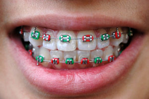 dental rubber bands